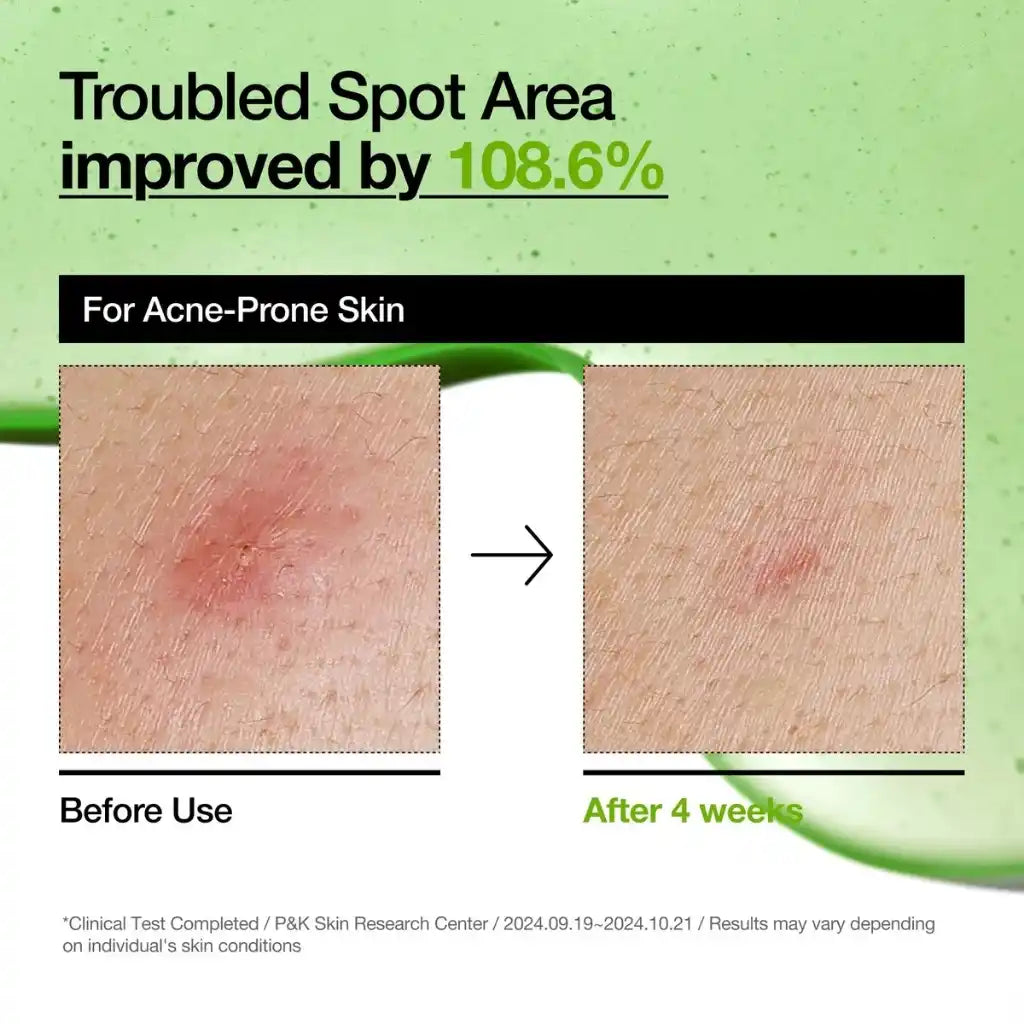 Anua Azelaic Acid 10 Hyaluron Redness Soothing Serum 30ml - Sérum apaisant pour peaux sensibles cruelty-free - peau acnéique - Skincare coréenne Skinorea shop France Paris livraison rapide - Kbeauty Korean Skinorea shop Europe fast delivery - yesstyle