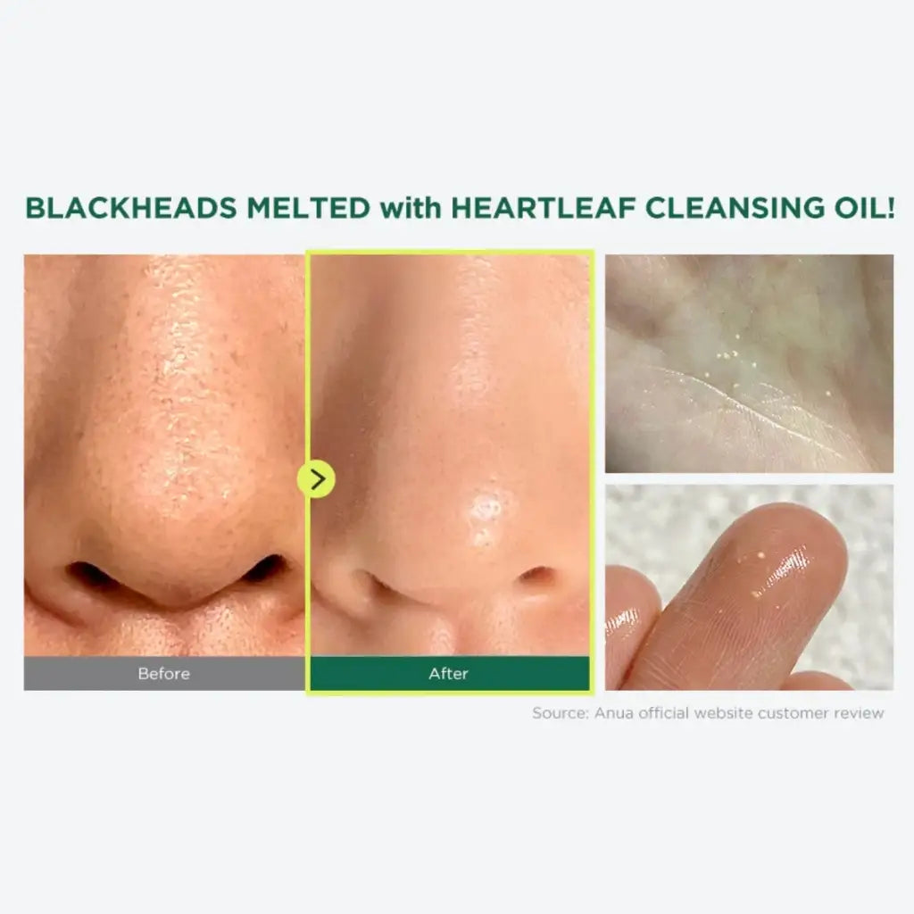 Anua Heartleaf Pore Control Cleansing Oil 200ml - Huile nettoyante vegan non comédogène - Avant Après - Kbeauty Korean skincare Europe fast delivery - Skincare coréenne Skinorea shop Paris France livraison rapide - yesstyle